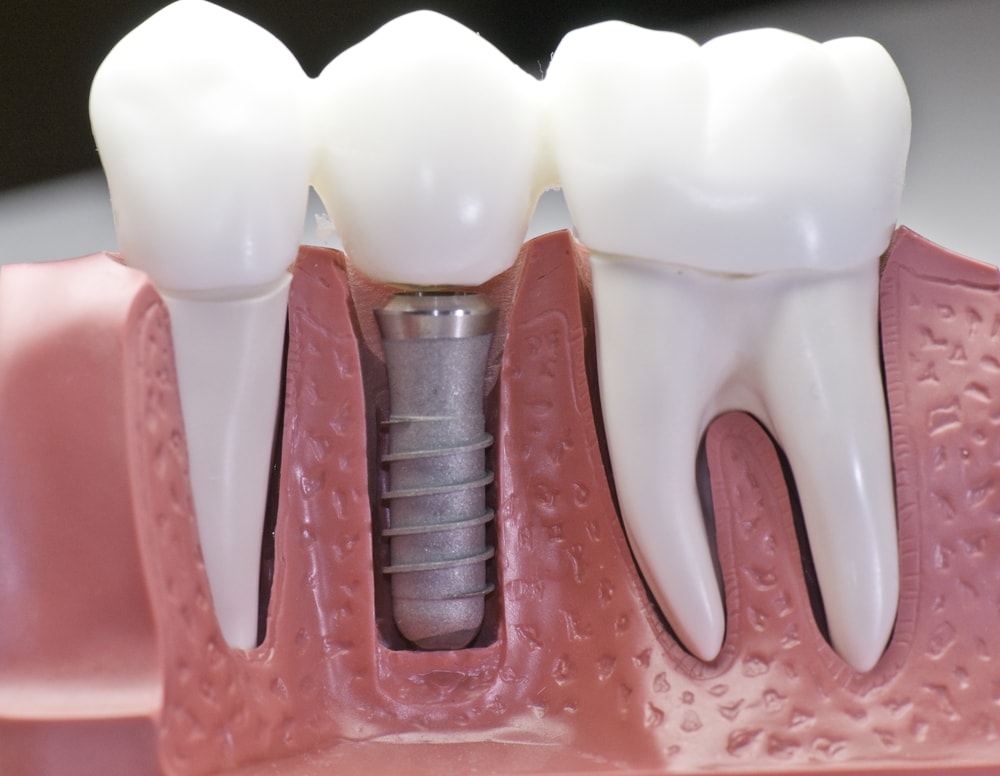 Discover The Best Dental Implants For A Perfect Smile
